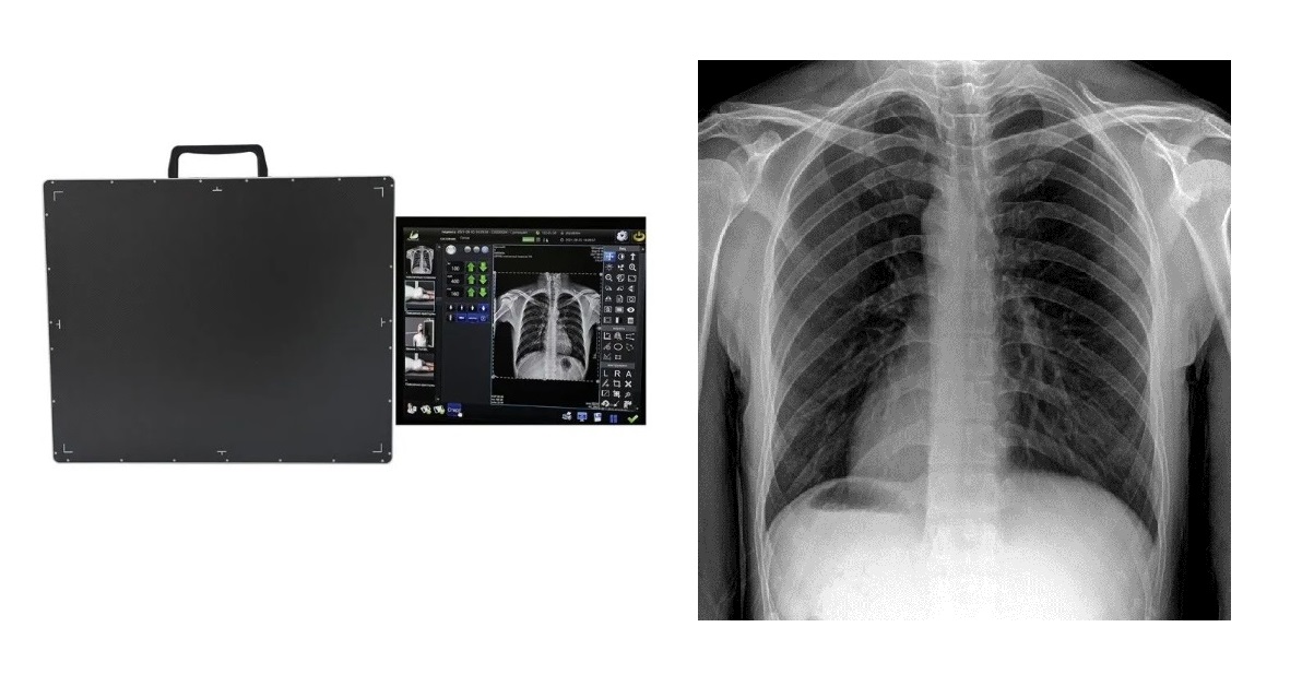 Siftable Flat Panel Detector For Full Coverage Chest Radiography Scenarios